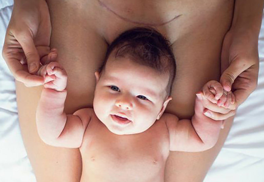 Comment se préparer à l'accouchement par césarienne ? – Daylily Paris
