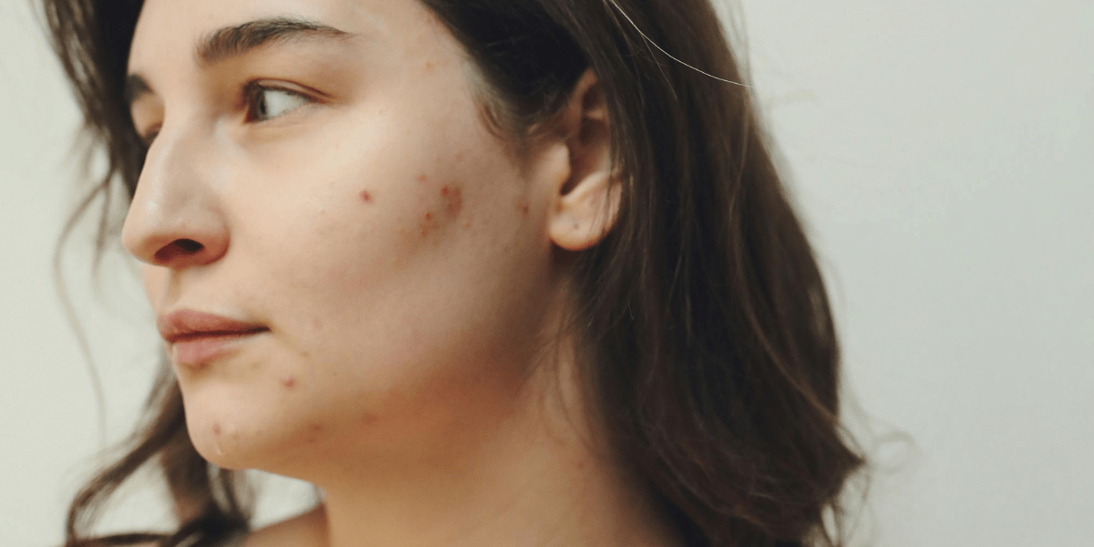 Acné de grossesse : comment apaiser les boutons avec des soins sûrs et efficaces ? - Daylily Paris