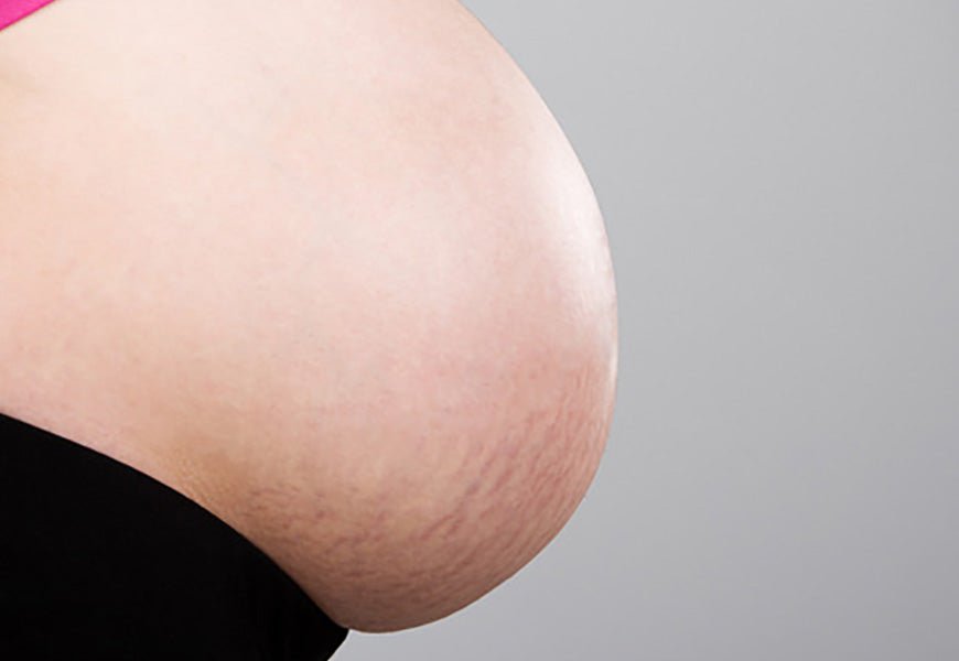 Fin de grossesse : comment éviter les vergetures ? - Daylily Paris