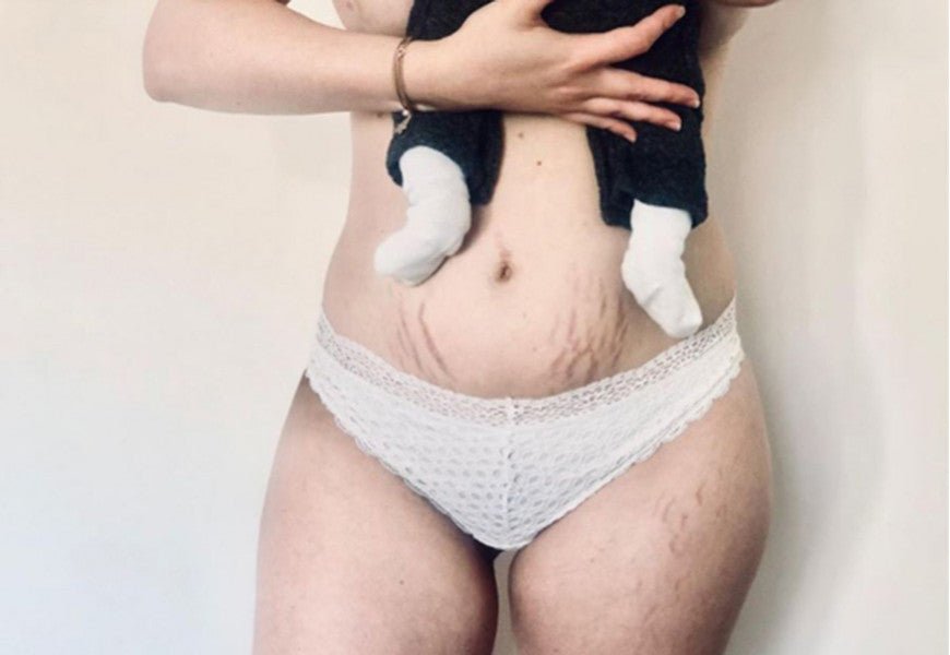 Grossesse : comment atténuer les vergetures violettes ? - Daylily Paris