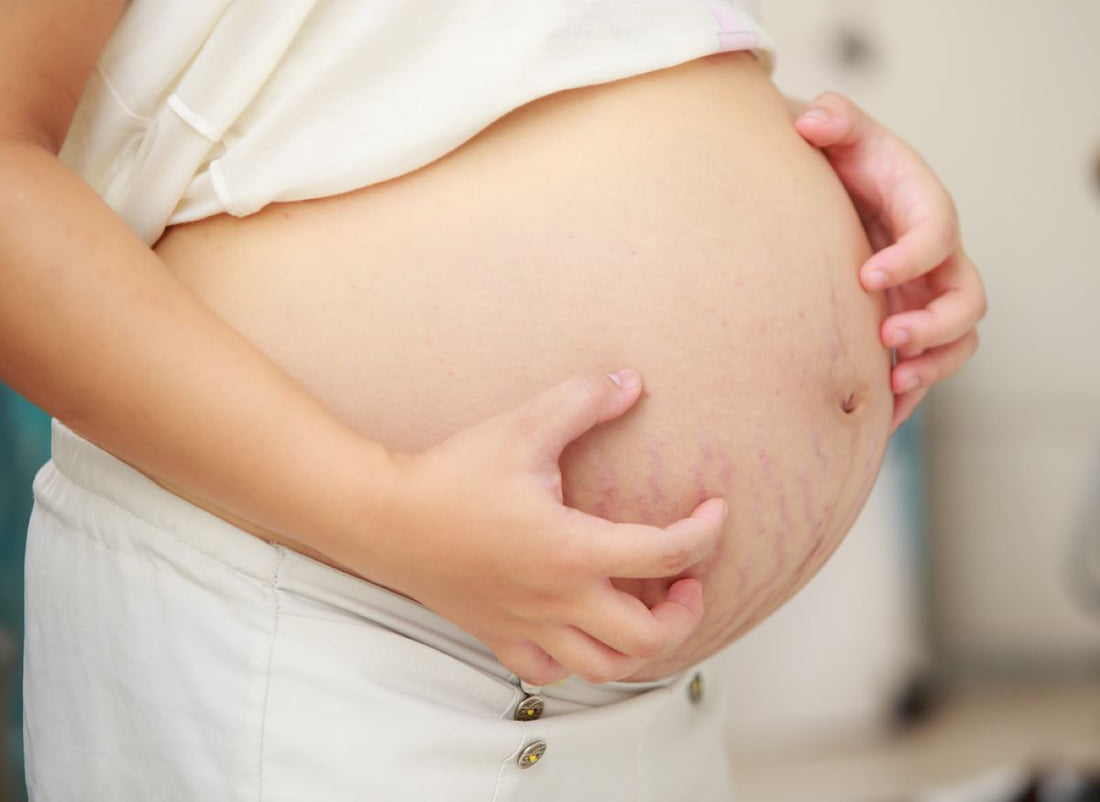 Grossesse : comment soulager la peau du ventre qui gratte ? - Daylily Paris