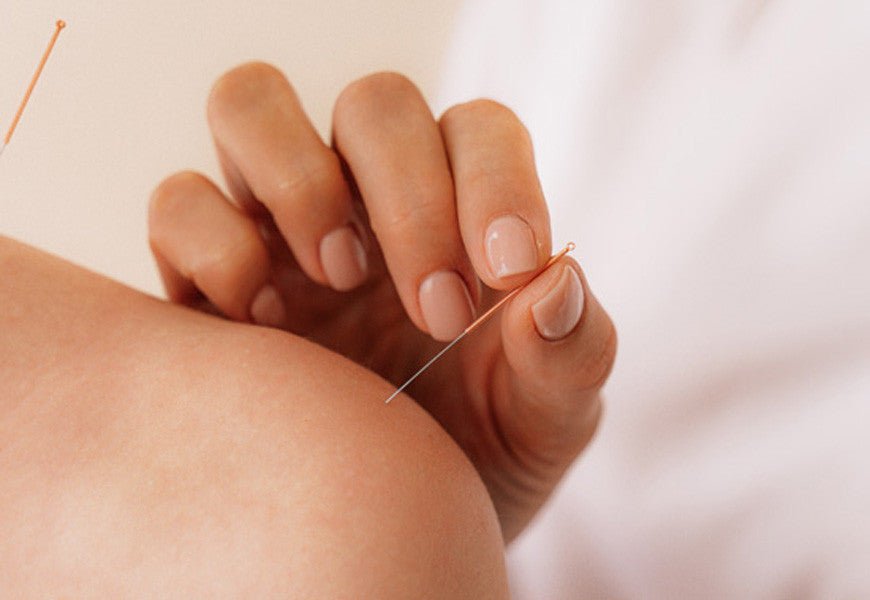 Les bienfaits de l’acupuncture après l’accouchement - Daylily Paris