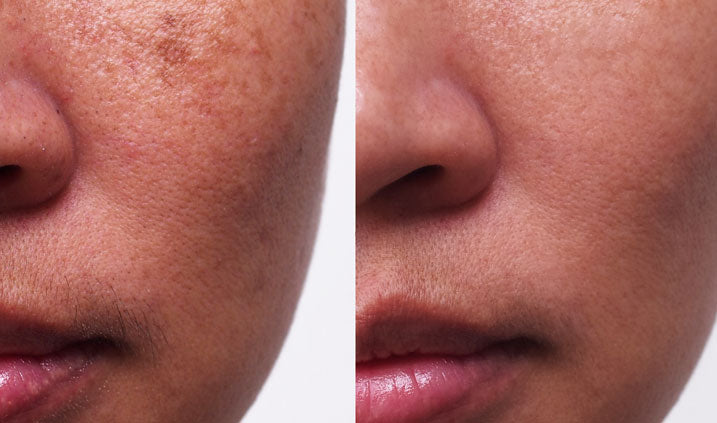 Melasma : comment faire disparaitre le masque de grossesse ?