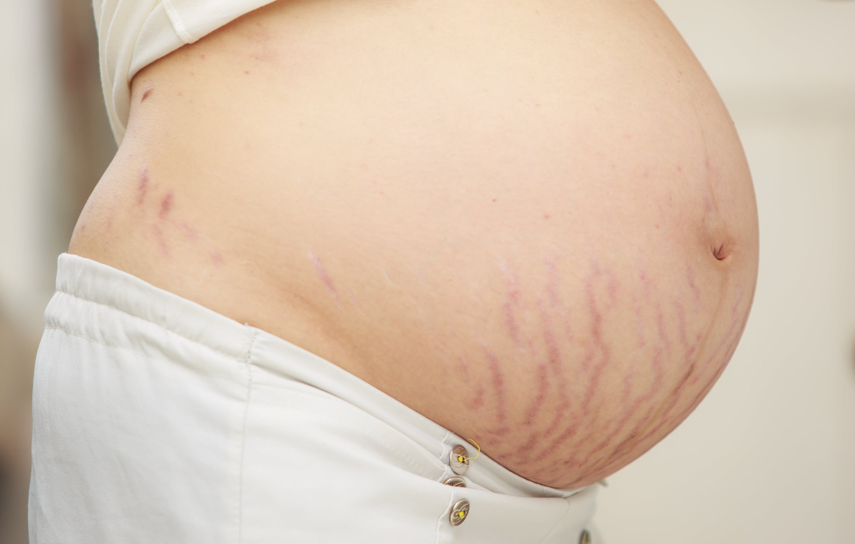 Vergetures rouges : quelles sont les causes et comment les atténuer ? - Daylily Paris