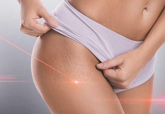 Vergetures sur les cuisses : comment les atténuer ? - Daylily Paris