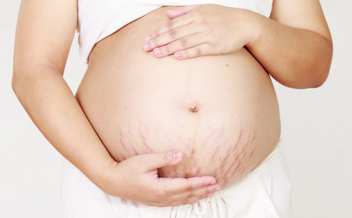 Vergeture grossesse : comment éviter les vergetures
